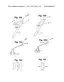 INTRANASAL BONE REMODELING DEVICES AND THEIR PLACE IN MINIMALLY INVASIVE     SINUS PROCEDURES diagram and image