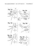 INTRANASAL BONE REMODELING DEVICES AND THEIR PLACE IN MINIMALLY INVASIVE     SINUS PROCEDURES diagram and image