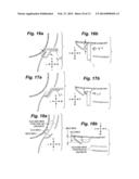 INTRANASAL BONE REMODELING DEVICES AND THEIR PLACE IN MINIMALLY INVASIVE     SINUS PROCEDURES diagram and image