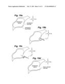 INTRANASAL BONE REMODELING DEVICES AND THEIR PLACE IN MINIMALLY INVASIVE     SINUS PROCEDURES diagram and image