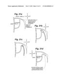 INTRANASAL BONE REMODELING DEVICES AND THEIR PLACE IN MINIMALLY INVASIVE     SINUS PROCEDURES diagram and image