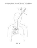 BRONCHIAL ISOLATION DEVICES FOR PLACEMENT IN SHORT LUMENS diagram and image