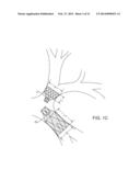 BRONCHIAL ISOLATION DEVICES FOR PLACEMENT IN SHORT LUMENS diagram and image