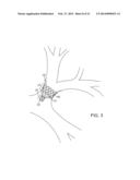 BRONCHIAL ISOLATION DEVICES FOR PLACEMENT IN SHORT LUMENS diagram and image