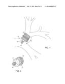 BRONCHIAL ISOLATION DEVICES FOR PLACEMENT IN SHORT LUMENS diagram and image