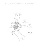 BRONCHIAL ISOLATION DEVICES FOR PLACEMENT IN SHORT LUMENS diagram and image