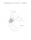 BRONCHIAL ISOLATION DEVICES FOR PLACEMENT IN SHORT LUMENS diagram and image