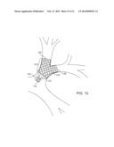 BRONCHIAL ISOLATION DEVICES FOR PLACEMENT IN SHORT LUMENS diagram and image