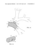 BRONCHIAL ISOLATION DEVICES FOR PLACEMENT IN SHORT LUMENS diagram and image