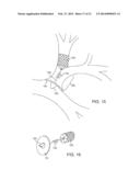 BRONCHIAL ISOLATION DEVICES FOR PLACEMENT IN SHORT LUMENS diagram and image