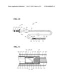 IMPLANT DELIVERY AND RELEASE SYSTEM diagram and image