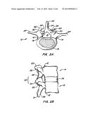 Minimally Invasive Spine Restoration Systems, Devices, Methods and Kits diagram and image