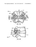 Minimally Invasive Spine Restoration Systems, Devices, Methods and Kits diagram and image