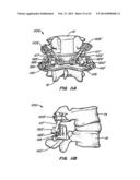 Minimally Invasive Spine Restoration Systems, Devices, Methods and Kits diagram and image