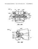 Minimally Invasive Spine Restoration Systems, Devices, Methods and Kits diagram and image