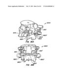 Minimally Invasive Spine Restoration Systems, Devices, Methods and Kits diagram and image