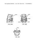 Minimally Invasive Spine Restoration Systems, Devices, Methods and Kits diagram and image