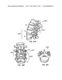 Minimally Invasive Spine Restoration Systems, Devices, Methods and Kits diagram and image