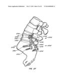 Minimally Invasive Spine Restoration Systems, Devices, Methods and Kits diagram and image