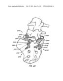 Minimally Invasive Spine Restoration Systems, Devices, Methods and Kits diagram and image