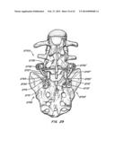 Minimally Invasive Spine Restoration Systems, Devices, Methods and Kits diagram and image