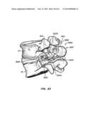 Minimally Invasive Spine Restoration Systems, Devices, Methods and Kits diagram and image