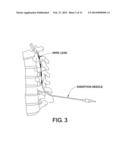 BIPOLAR SPINAL CORD STIMULATION TO ACTIVATE THE EXPIRATORY MUSCLES TO     RESTORE COUGH diagram and image