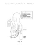 BIPOLAR SPINAL CORD STIMULATION TO ACTIVATE THE EXPIRATORY MUSCLES TO     RESTORE COUGH diagram and image