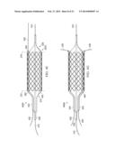 Deployment of Stents within Bifurcated Vessels diagram and image