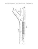 Deployment of Stents within Bifurcated Vessels diagram and image