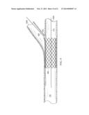 Deployment of Stents within Bifurcated Vessels diagram and image