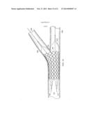 Deployment of Stents within Bifurcated Vessels diagram and image