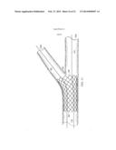 Deployment of Stents within Bifurcated Vessels diagram and image