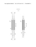 Deployment of Stents within Bifurcated Vessels diagram and image