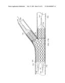 Deployment of Stents within Bifurcated Vessels diagram and image