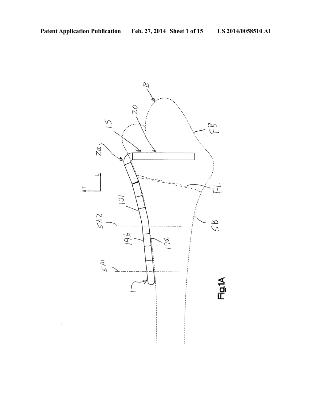 BONE IMPLANT - diagram, schematic, and image 02