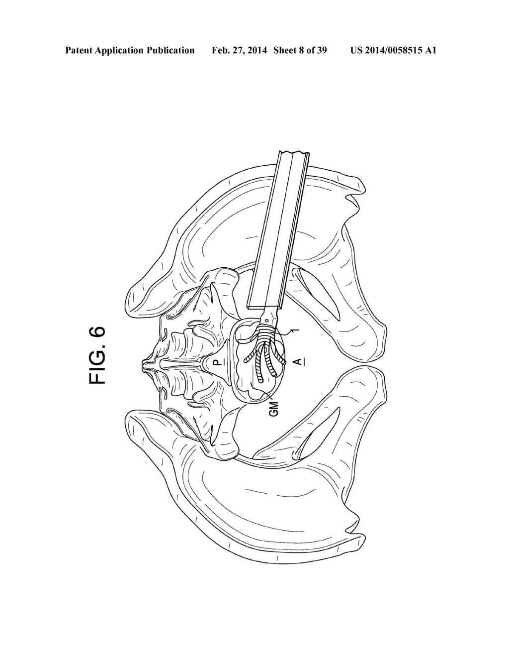 SURFACE EXPANDING SPACER - diagram, schematic, and image 09