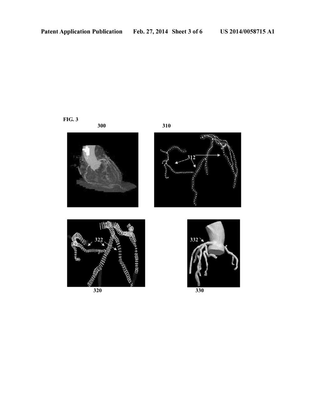 Method and System for Non-Invasive Functional Assessment of Coronary     Artery Stenosis - diagram, schematic, and image 04