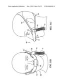 PATIENT INTERFACE DEVICE diagram and image