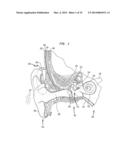 REMOVABLE ATTACHMENT OF A PASSIVE TRANSCUTANEOUS BONE CONDUCTION DEVICE     WITH LIMITED SKIN DEFORMATION diagram and image