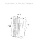 REMOVABLE ATTACHMENT OF A PASSIVE TRANSCUTANEOUS BONE CONDUCTION DEVICE     WITH LIMITED SKIN DEFORMATION diagram and image