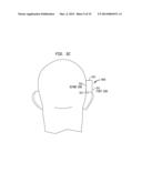 REMOVABLE ATTACHMENT OF A PASSIVE TRANSCUTANEOUS BONE CONDUCTION DEVICE     WITH LIMITED SKIN DEFORMATION diagram and image