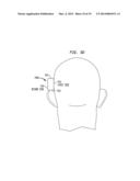 REMOVABLE ATTACHMENT OF A PASSIVE TRANSCUTANEOUS BONE CONDUCTION DEVICE     WITH LIMITED SKIN DEFORMATION diagram and image