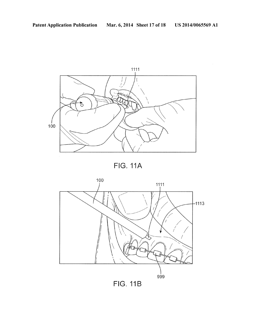 METHOD AND DEVICE FOR CAUSING TOOTH MOVEMENT - diagram, schematic, and image 18