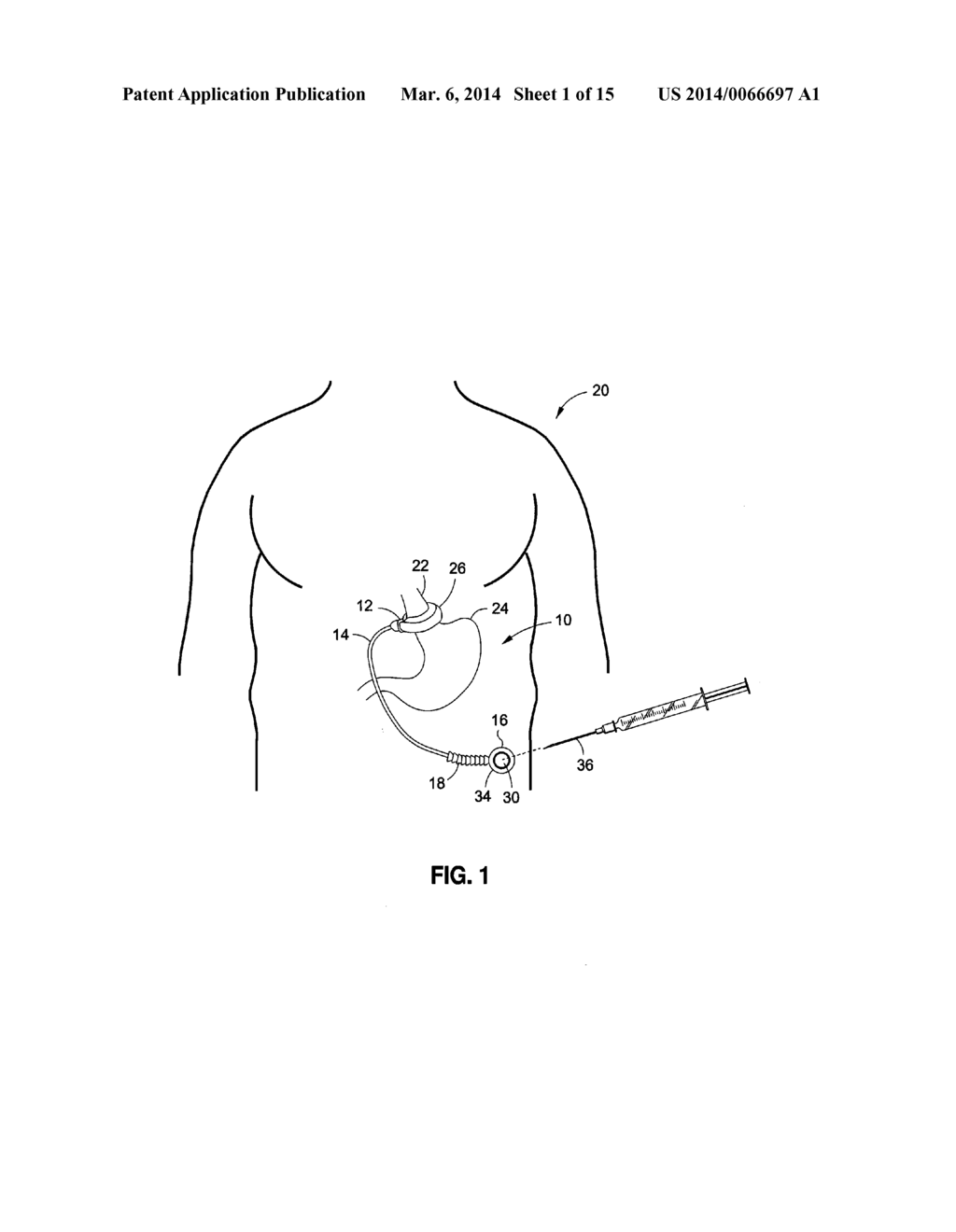 IMPLANTABLE DEVICE TO PROTECT TUBING FROM PUNCTURE - diagram, schematic, and image 02