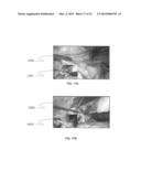 METHOD FOR MINIMALLY INVASIVE SURGERY STEROSCOPIC VISUALIZATION diagram and image