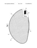 PROSTHETIC IMPLANT SHELL diagram and image