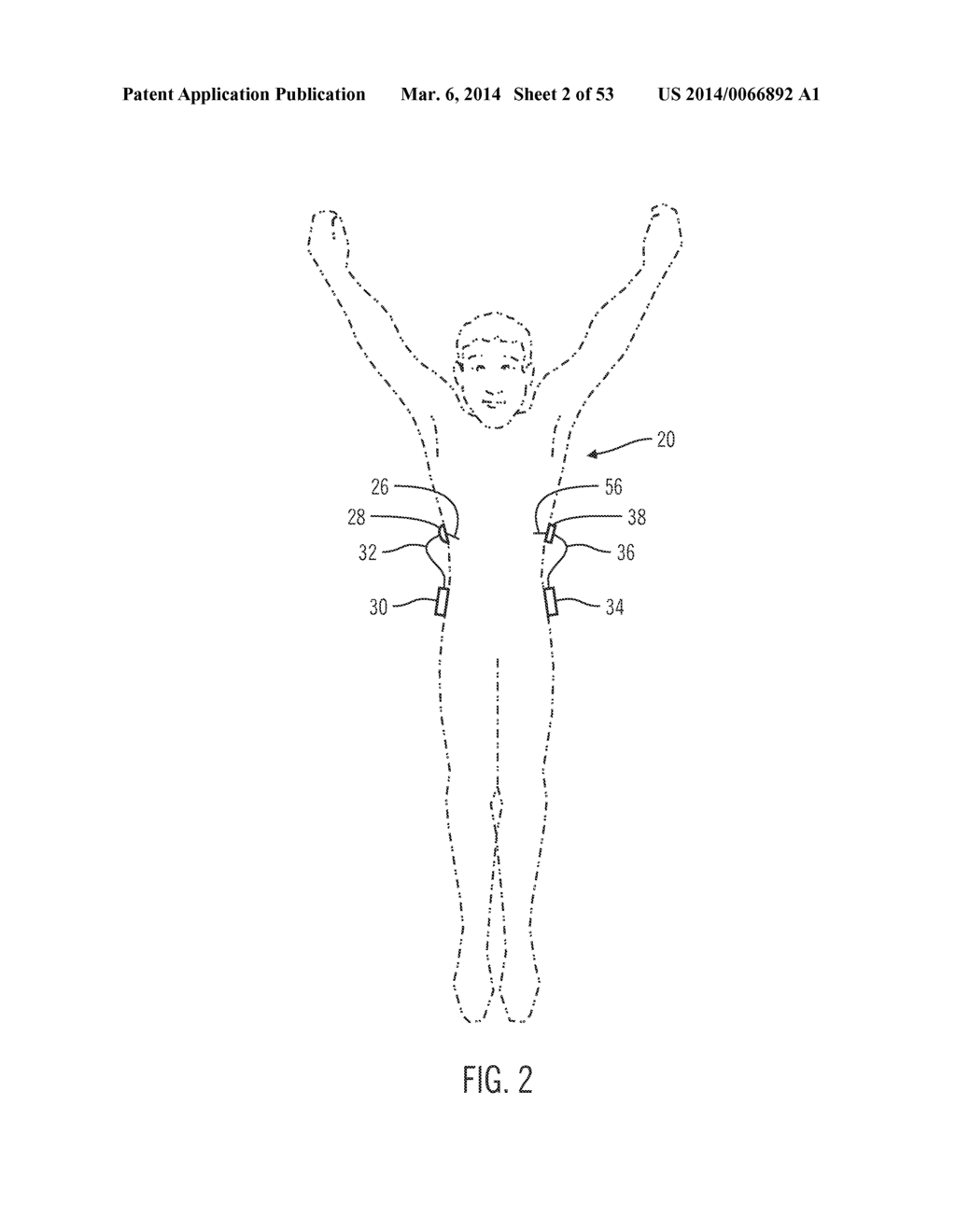 INSULIN ON BOARD COMPENSATION FOR A CLOSED-LOOP INSULIN INFUSION SYSTEM - diagram, schematic, and image 03