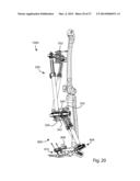 EXTERNAL FIXATION diagram and image