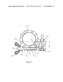 EXTERNAL FIXATION diagram and image